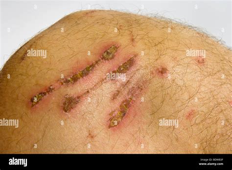 diver knee dermabrasion hurt skin scratch scuff abrasion of corals ...