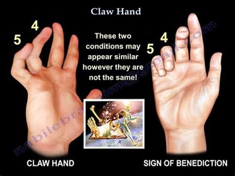 Claw Hand: Penyebab, Diagnosis, Dan Perawatan | Gejala dan penyakit 2024