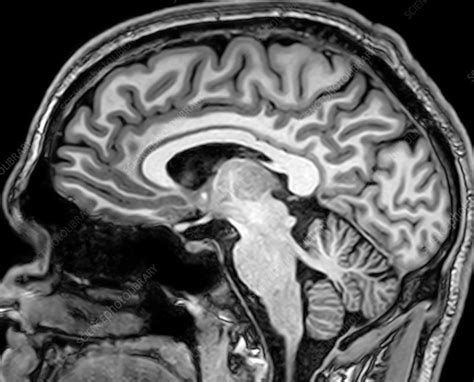 Normal Sagittal Brain Mri | Porn Sex Picture