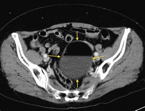 Ovarian dermoid - Radiology at St. Vincent's University Hospital