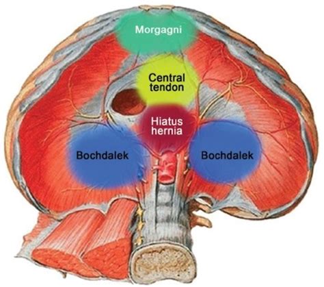 Congenital Diaphragmatic Hernia - The Operative Review Of Surgery