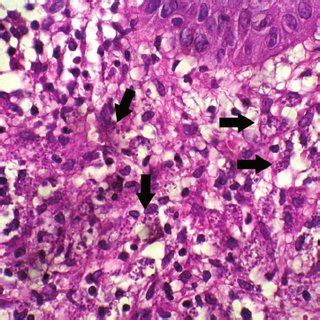 Cytologic Findings in 11 Cases of Mucosal Leishmaniasis | Download Table