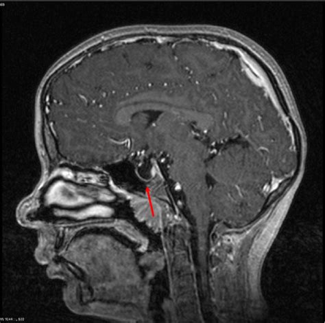 Empty sella. MRI Scan of the brain. Sagittal, T2-weighted. The arrow ...