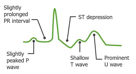 Hypokalemia (Clinical) | Concise Medical Knowledge