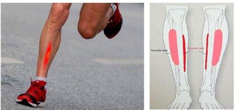 Tibial periostitis or runner's disease