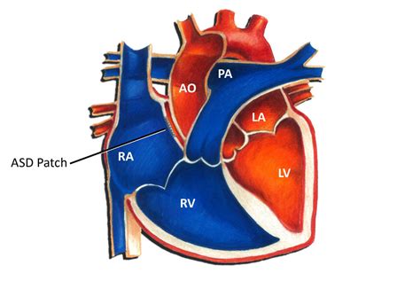 Atrial Septal Defect - Surgery - Pediatric Heart Specialists