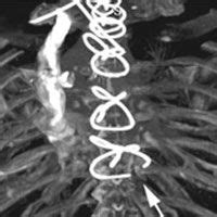 Sternum Wires & Heart Surgery: Implantation, MRIs & Removal