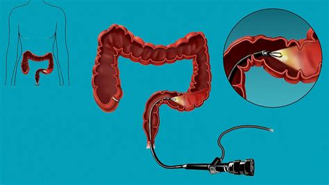 What’s a Sigmoidoscopy? All About Testing and Diagnosis