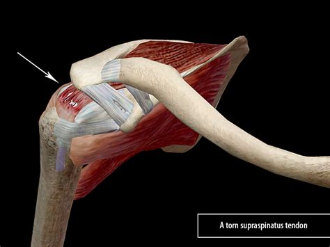 Rotator Cuff Partial Tear Supraspinatus | Images and Photos finder