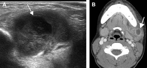 Ultrasonography of Cervical Lymph Nodes - Radiologic Clinics