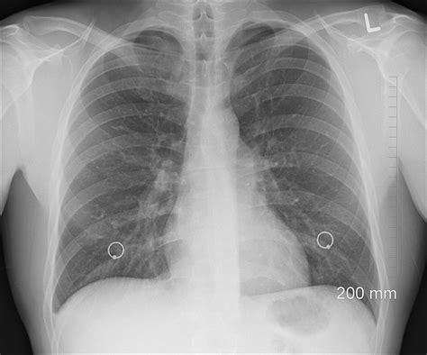 Warning Signs Of Lung Cancer