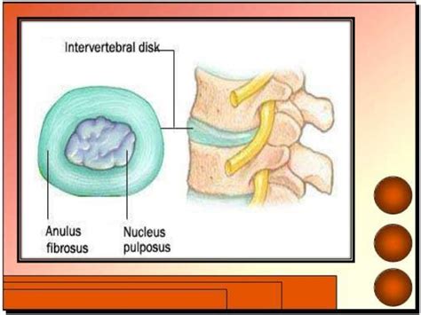 Herniated Nucleus Pulposus