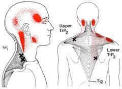 Pin on Myofascia and Trigger Point