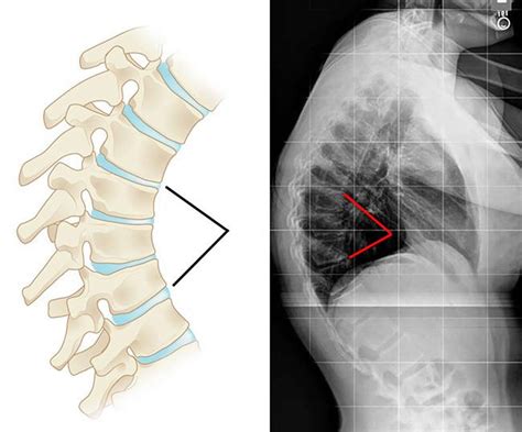 Kyphosis - Causes, Symptoms, Exercises, Surgery, Treatment