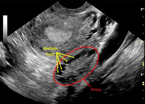 PCOS and Fertility in Women | Conception Advice