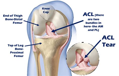 ACL Surgery Alternative? Meet the Perc-ACLR Procedure