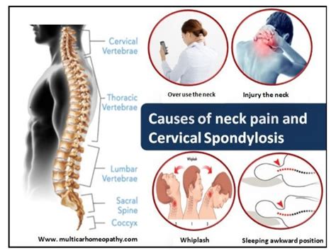 CERVICAL SPONDYLOSIS.