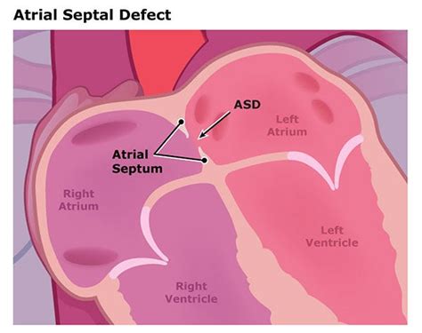 Atrial Septal Defect Anatomy