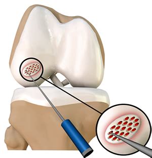 Arthroscopic Debridement of The Knee London, UK | Knee Osteoarthritis ...