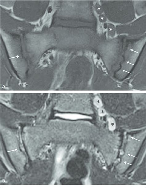 Multiple active and structural features of sacroiliitis seen on MRI in ...