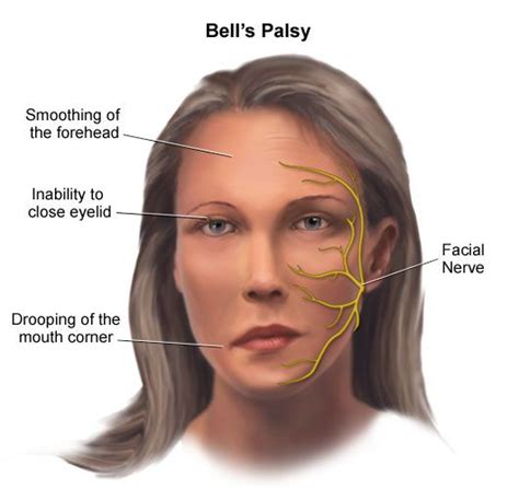 Bell's Palsy- All You Need To Know - Elevate Physiotherapy