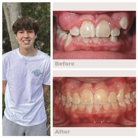 Get Clear Braces That Match The Color Of Your Teeth