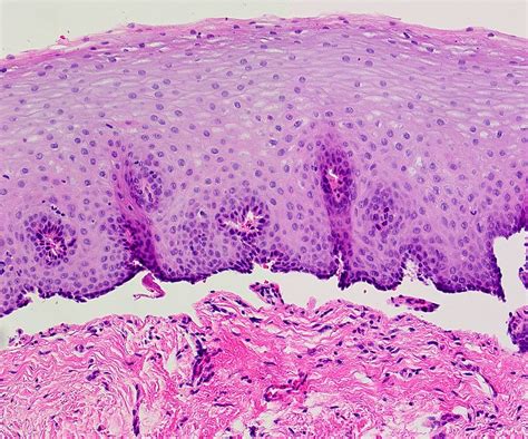 Mucous Membrane Pemphigoid Histology