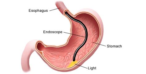 Esophagogastroduodenoscopy - EGD - Medical Test | Stanford Health Care