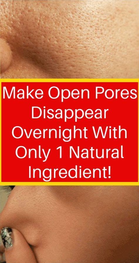 Get Rid Of Open Pores Naturally In Just 3 Days With These Powerful Home ...