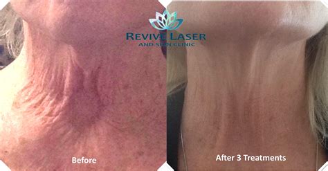 Neck tightening - before and after - Revive Laser and Skin Clinic