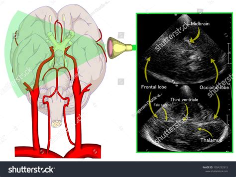 Illustration Shown Transcranial Doppler Sonography On Stock ...