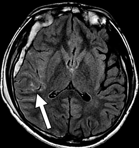 Traumatic Brain Injury Mri