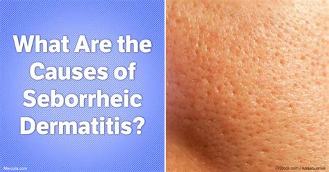 What Are the Causes of Seborrheic Dermatitis?