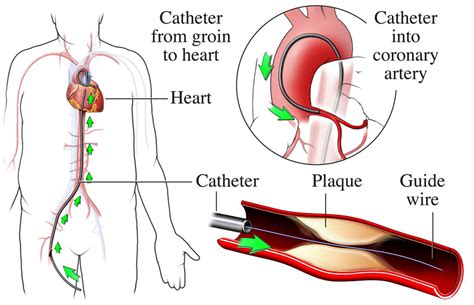 Cardiac Catheterization - During Cardiac Catheterization | NHLBI, NIH