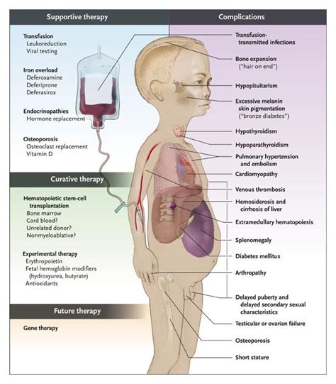 Thalassemia - HardeepBrionni