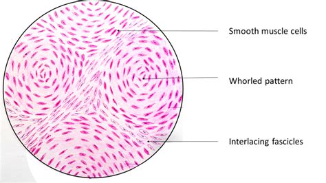 Leiomyoma: Uterus - Pathology Made Simple