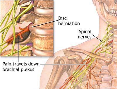 Treatment of Pinched Nerve in the Neck in NJ | Pain Management Doctor