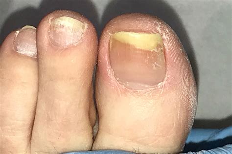 What Should I do If My Nails Are Fungal? – Care For Feet