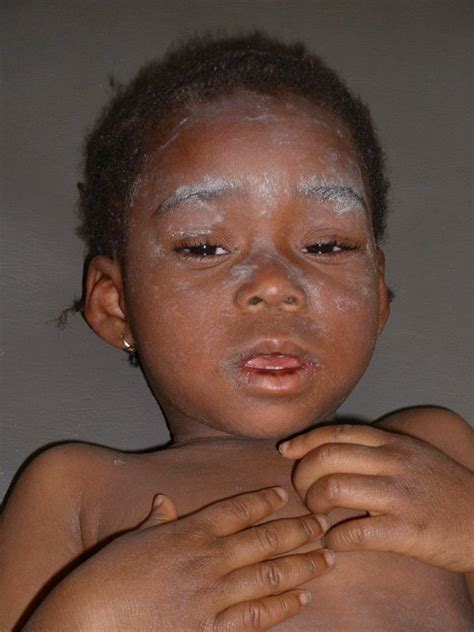 Kaduna State Primary Health Care Agency to Commence Measles Vaccination ...