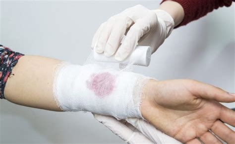 Providing First Aid While Venous and Capillary Bleeding - fitness and ...