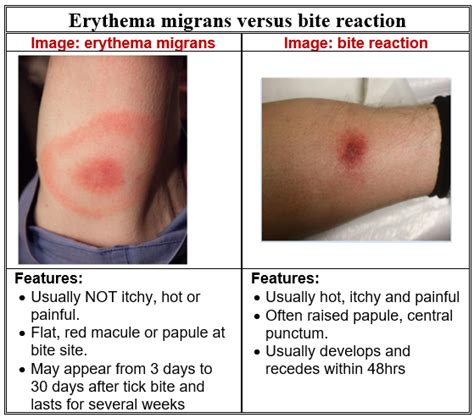 Lyme Disease - HSE.ie