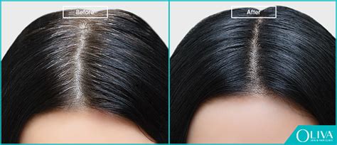 PCOS Hair Loss: Best Treatments Regrow Lost Hair