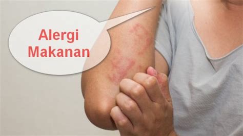 Alergi Makanan - Dokter Alergi