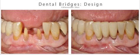 Dental Bridges by Seattle Expert Dentist. Teeth Replacement. Shor Dental