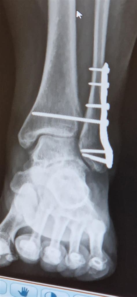 X-ray of my left ankle ORIF for (iirc) a distal fibula and posterior ...