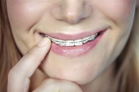 Pros And Cons Of Ceramic Braces | Carrie Muzny DDS