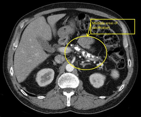 Chronic pancreatitis CT - wikidoc