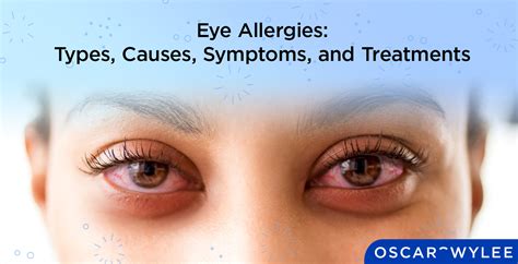 Eye Allergies Types Causes Symptoms And Treatments – NBKomputer