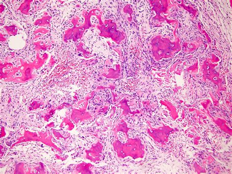 Osteoblastoma Histology