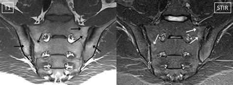 Defining active sacroiliitis on MRI for classification of axial ...